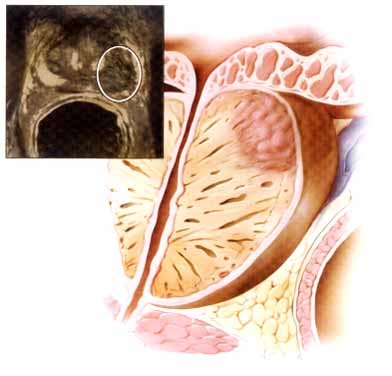 Cancerul prostatei - cancer la prostata